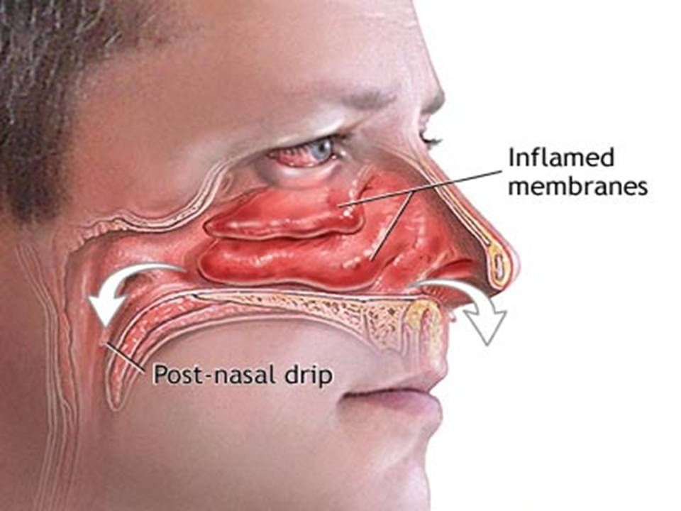 choanal atresia