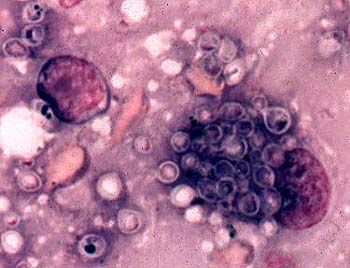 Histoplasma on histoplasmoosin aiheuttaja