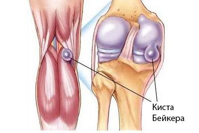Bakerin kysta