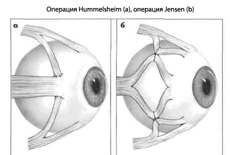 Strabismus - leikkaus