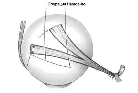 Strabismus - leikkaus