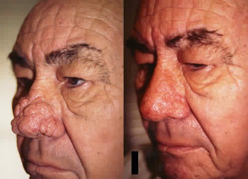 Rhinophyma