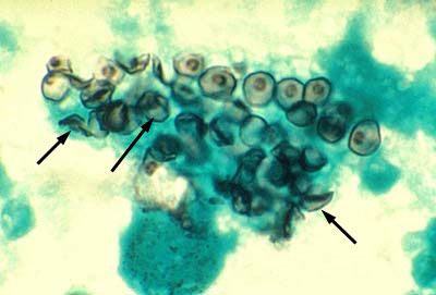 Pneumocystis (Pneumocystis jiroveci)