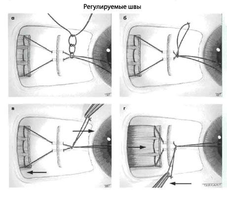 Strabismus - leikkaus