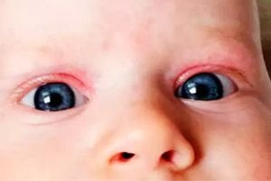 Vastasyntyneen Punaiset Silmaluomet Syyt Seuraukset Hoito Osaaminen Terveydenhuollosta Ilivessa